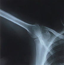 shoulder x ray